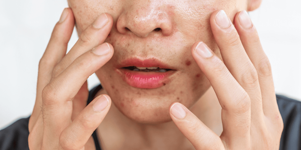 Oily, Sun Damaged Skin Care