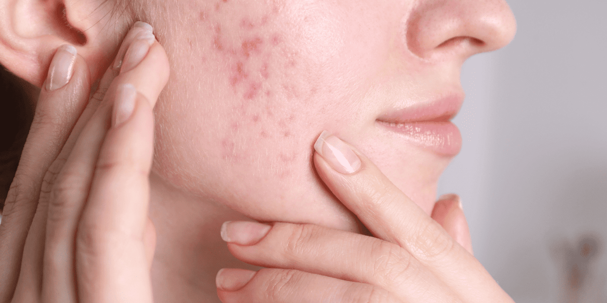 Hormonal Acne Skin Care